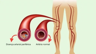 Triệu chứng, nguyên nhân và cách điều trị bệnh động mạch ngoại biên