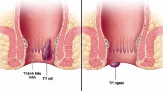 Hiểu đúng về bệnh trĩ để phòng ngừa hiệu quả