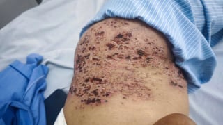 Hà Nội: Tiếp nhận nữ bệnh nhân 73 tuổi da bị lỗ chỗ như tổ ong vì đắp đậu xanh chữa zona thần kinh