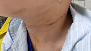 Hà Nội: Cấp cứu cho bệnh nhi bị tai nạn hi hữu trong sinh hoạt