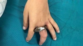 Hà Nội: Cấp cứu kịp thời cho trẻ nhỏ bị kẹt ngón tay trong ổ khóa tránh nguy cơ hoại tử ngón tay