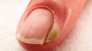 Thực hư cắt móng tay quá ngắn có nguy cơ bị bệnh tim?