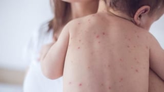 Sởi - Bệnh truyền nhiễm nguy hiểm ở trẻ em