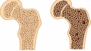 5 cơn đau nào là dấu hiệu của bệnh loãng xương?