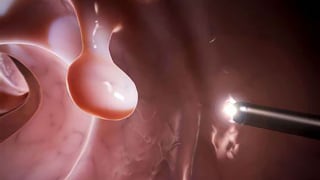 Cách điều trị polyp theo y học cổ truyền