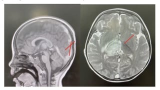 Bé trai mắc huyết khối tĩnh mạch nội sọ nặng do nguyên nhân hiếm gặp