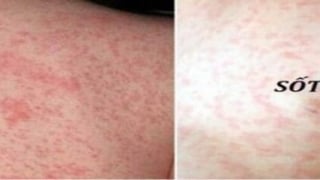 Biến chứng nguy hiểm của bệnh sởi ở trẻ em