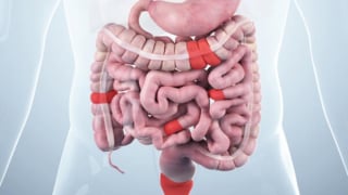 Bệnh Crohn - Sát thủ thầm lặng trong hệ tiêu hóa