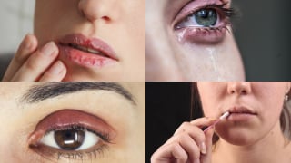 Phun xăm môi, mắt: Cảnh báo những biến chứng không thể xem nhẹ