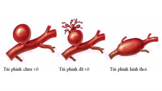 Mắc phình mạch máu não, làm sao để ngủ ngon mỗi đêm?