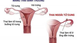 Sau sảy thai, cơ thể phụ nữ sẽ thay đổi ra sao?