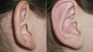Biến chứng khi chạy theo mốt “tai tài lộc, tai yêu tinh”