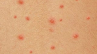 Cảnh báo biến chứng nguy hiểm của bệnh thủy đậu