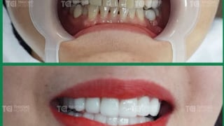 Lấy lại nụ cười tự tin với dịch vụ bọc răng sứ tại TCI