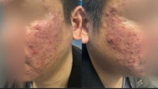 Viêm da mặt kéo dài, người bệnh bất ngờ phát hiện nhiễm ký sinh trùng Demodex