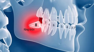 Những lưu ý quan trọng trước khi nhổ răng khôn