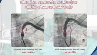 Hải Phòng: Bệnh viện Hữu nghị Việt Tiệp can thiệp thành công hội chứng “ăn cắp máu”, phục hồi tuần hoàn máu lên não cho bệnh nhân cao tuổi