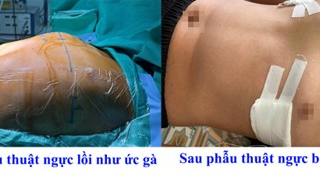 Ngực lồi lên như ức gà, cậu bé 12 tuổi thay đổi ngoại hình ngoạn mục sau khi đến Bệnh viện Đa khoa tỉnh Phú Thọ