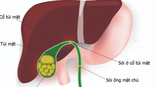 Phát hiện sỏi túi mật kịp thời để điều trị