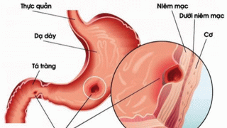 Biến chứng nguy hiểm của viêm loét dạ dày