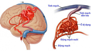 Chuyên gia chỉ ra 6 nguyên nhân đột quỵ não ở người trẻ tuổi