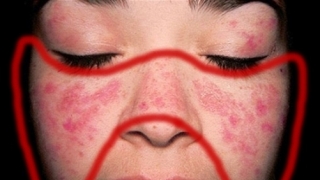 Người bị lupus ban đỏ kiêng ăn gì