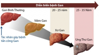 Ung thư gan sống được bao lâu ?