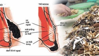 Cách chữa bệnh trĩ bằng bài thuốc đông y