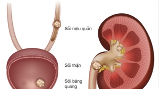 Mùa nào dễ bị mắc bệnh sỏi thận ?