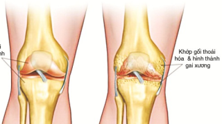Đau khớp gối là dấu hiệu bệnh gì?