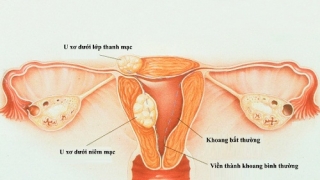 Phẫu thuật u xơ tử cung bao lâu thì khỏi?