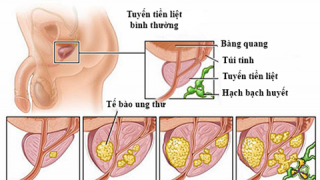 Ung thư tuyến tiền liệt sống được bao lâu?