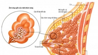 Phẫu thuật áp xe vú bao lâu thì khỏi?