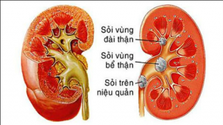 Sau phẫu thuật sỏi thận nên ăn gì?