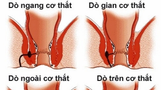 Phẫu thuật rò hậu môn bao lâu thì khỏi?