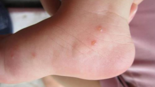 Côn trùng cắn nổi mụn nước có nguy hiểm không và cách chữa trị khi bị côn trùng cắn?