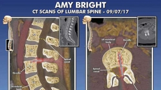 Suýt bị liệt vì bác sĩ bỏ quên kim gây tê trong cột sống