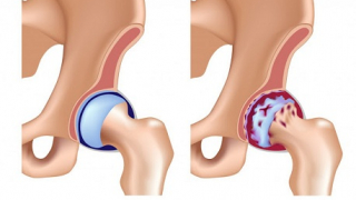 Triệu chứng của viêm khớp háng