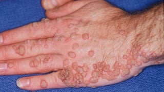 Bệnh sùi mào gà có bị ngứa không?