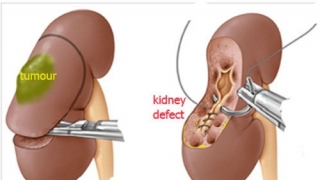 Phẫu thuật cắt thận bao lâu thì khỏi?