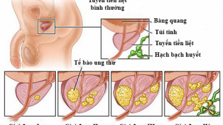 U xơ tiền liệt tuyến dùng uống thuốc gì?