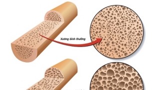 Cách chữa bệnh loãng xương ở người già