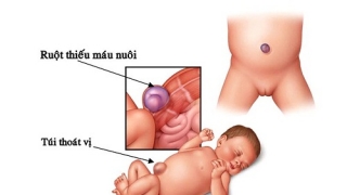 Phẫu thuật thoát vị rốn bao lâu thì khỏi?