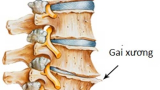 Phẫu thuật gai cột sống bao lâu thì khỏi?