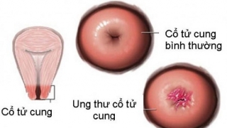 Các nguyên nhân dẫn đến ung thư cổ tử cung