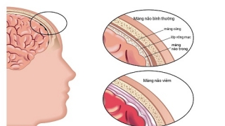 Viêm màng não có chữa được không?