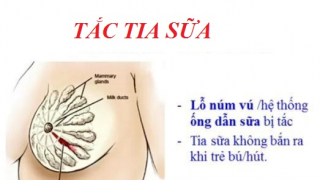 Mách bạn kinh nghiệm chữa tắc tia sữa cực dễ làm mà lại hiệu quả