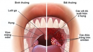 Cách ngừa viêm họng khi thời tiết nắng mưa thất thường