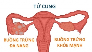 Phụ nữ bị đa nang buồng trứng có thai được không?