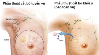 Sau phẫu thuật ung thư vú nên ăn gì?